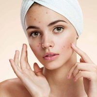 Microneedling