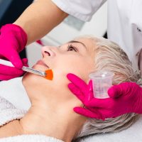 Chemical Peels